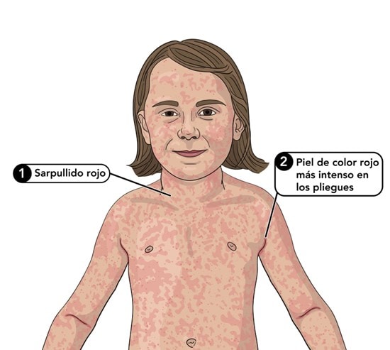 Ilustración de un niño con salpullido por escarlatina.