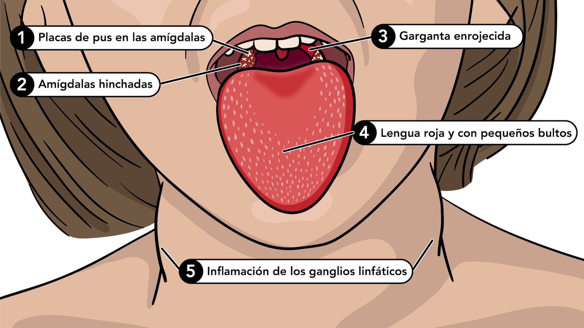 Los síntomas de la escarlatina incluyen la lengua roja y con pequeños bultos, garganta roja, amigdalas hinchadas y glangeos linfáticos inflamados.