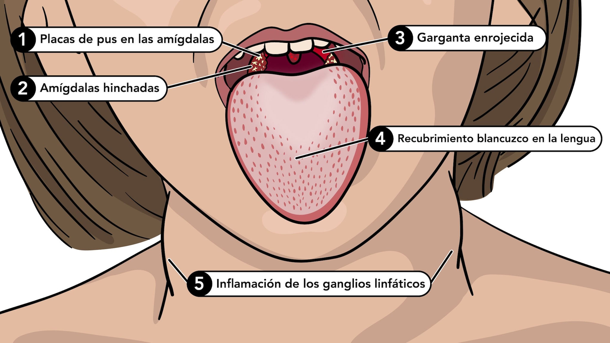 Los síntomas de la escarlatina incluyen lengua blanca, garganta roja, amigdalas hinchadas y ganglios linfáticos inflamados.