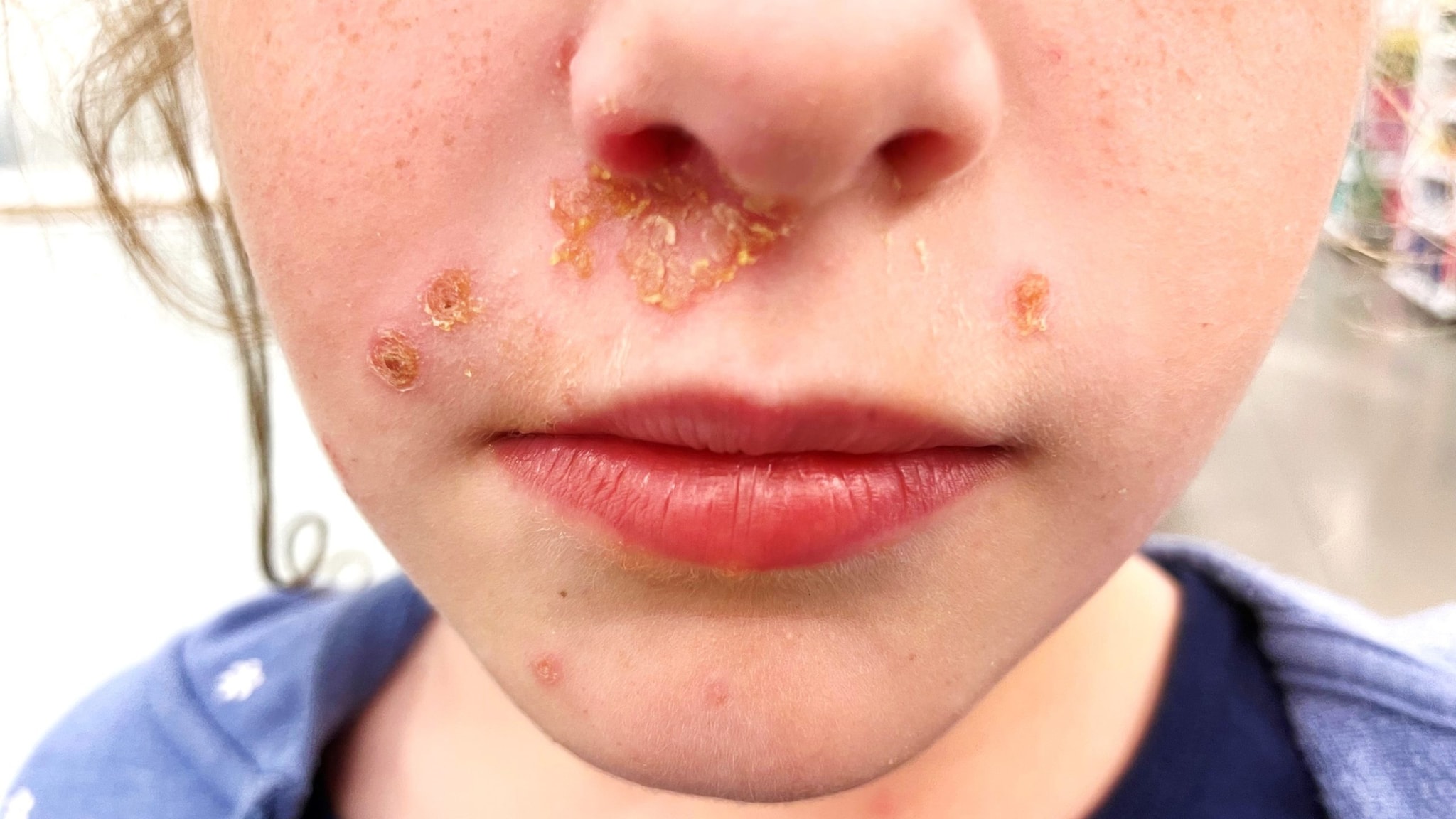 About Impetigo | Group A Strep | CDC