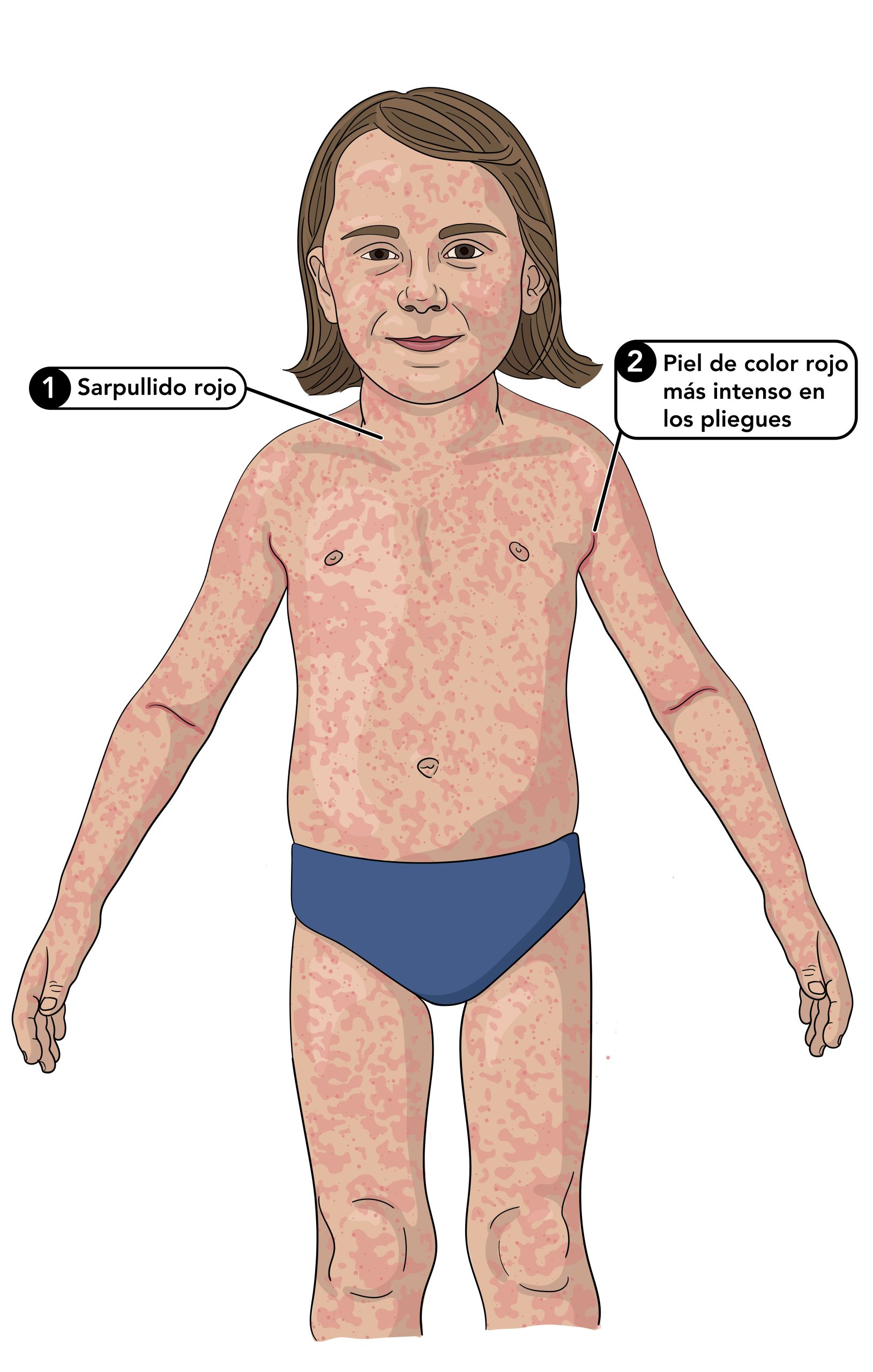 Sarpullido de escarlatina en un niño pequeño que también muestra líneas de pastia en los pliegues de la piel.