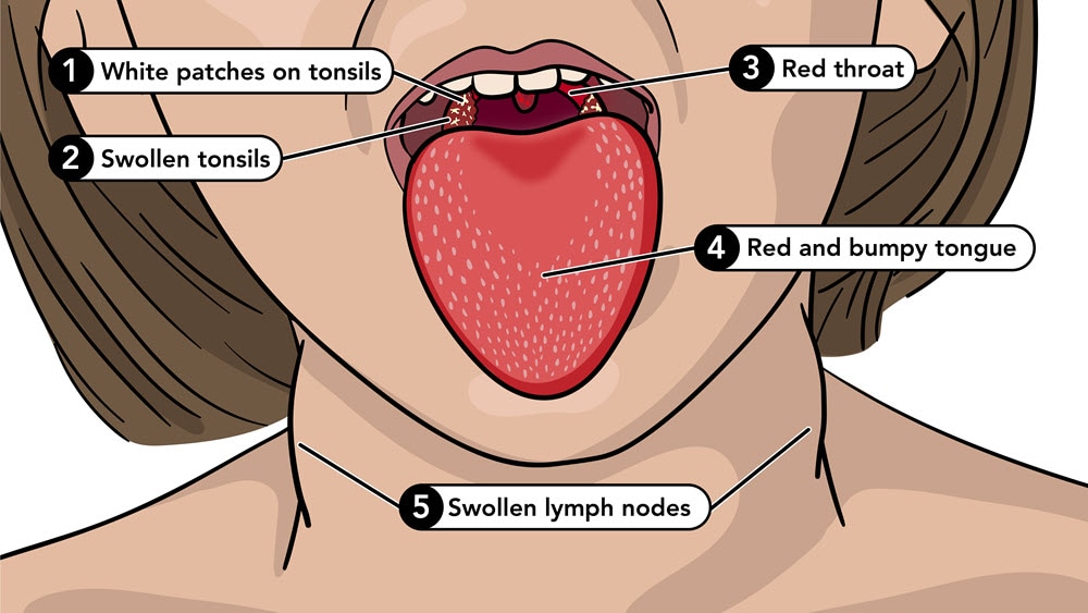 Symptoms of scarlet fever include a red and bumpy tongue, red throat, swollen tonsils, and swollen lymph nodes.