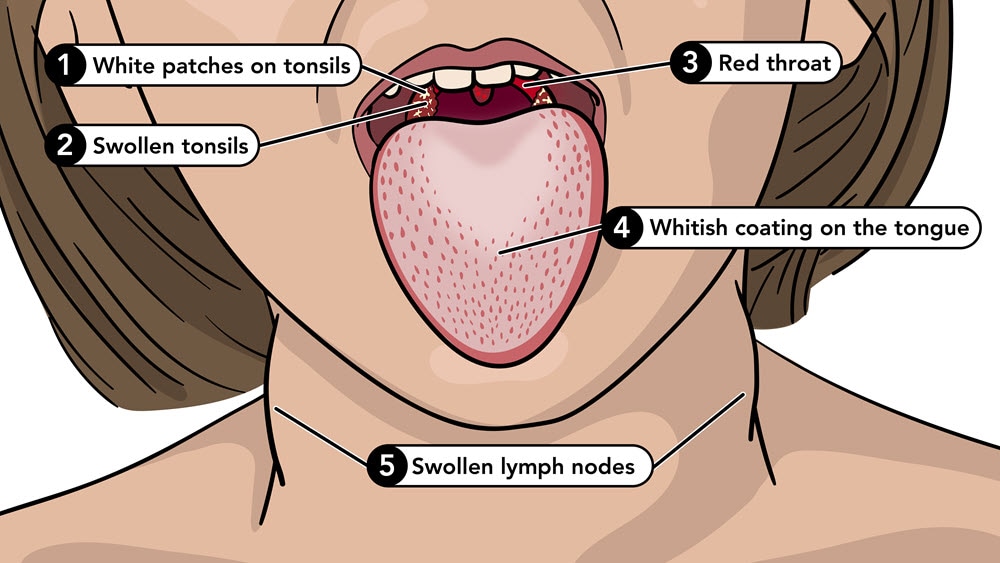 Symptoms of scarlet fever include a white tongue, red throat, swollen tonsils, and swollen lymph nodes.