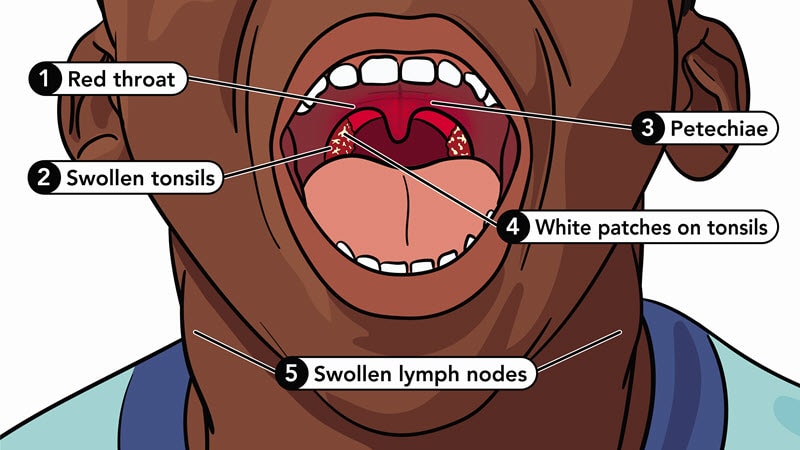 close-up of the inside of the mouth of a person with strep throat labeled with the names of the parts of the inside of the mouth