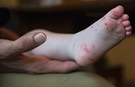 menú Instantáneamente tirano Síntomas y diagnóstico de la enfermedad de manos, pies y boca | CDC
