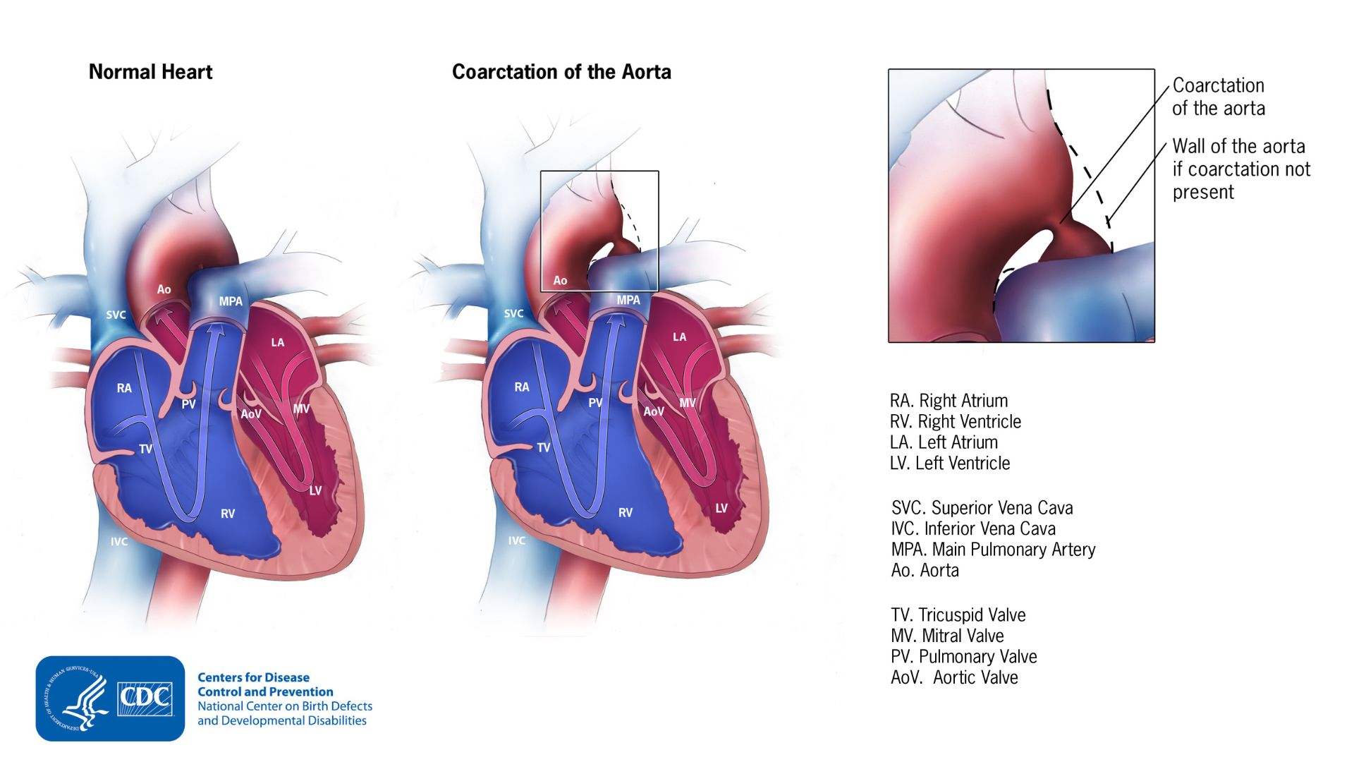 Normal heart to the left, heart with a coarctation of the aorta in the middle, and an enlarged view the coarctation in the upper right
