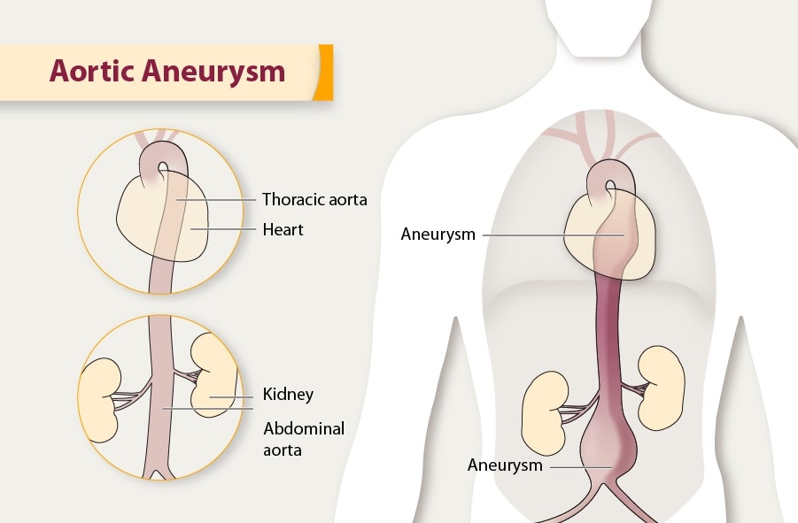 abdominal aortic aneurysm xray