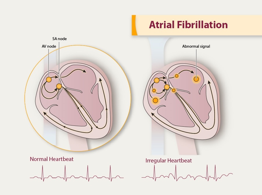 atrial fibrillation ivcd