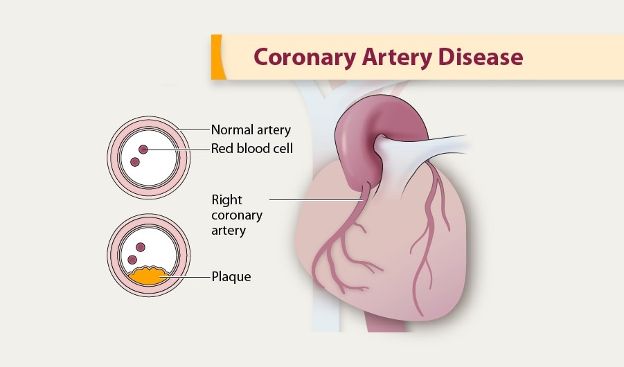 coronary artery disease pathophysiology diagram