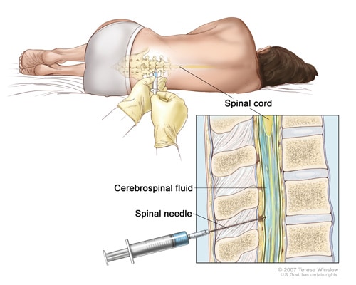 side effects after lumbar puncture