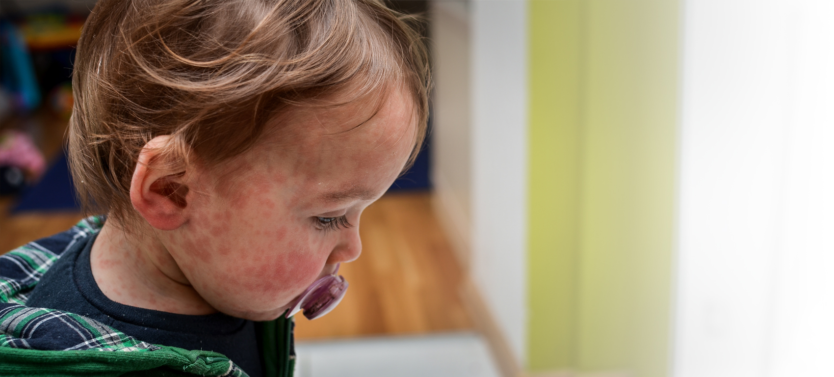 Measles