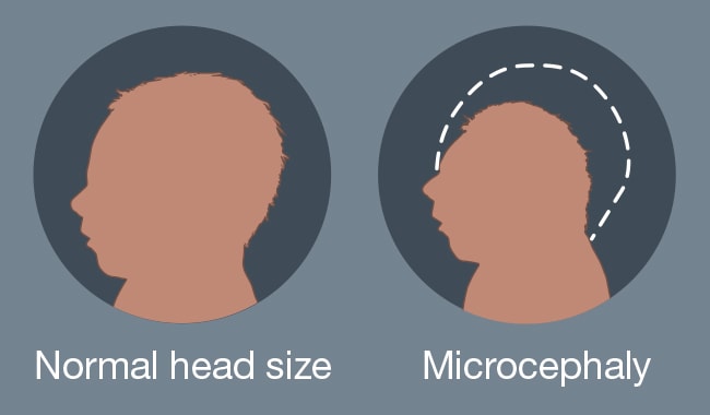 Illustration of infant head size
