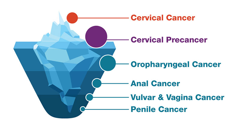 cervical cancer causes