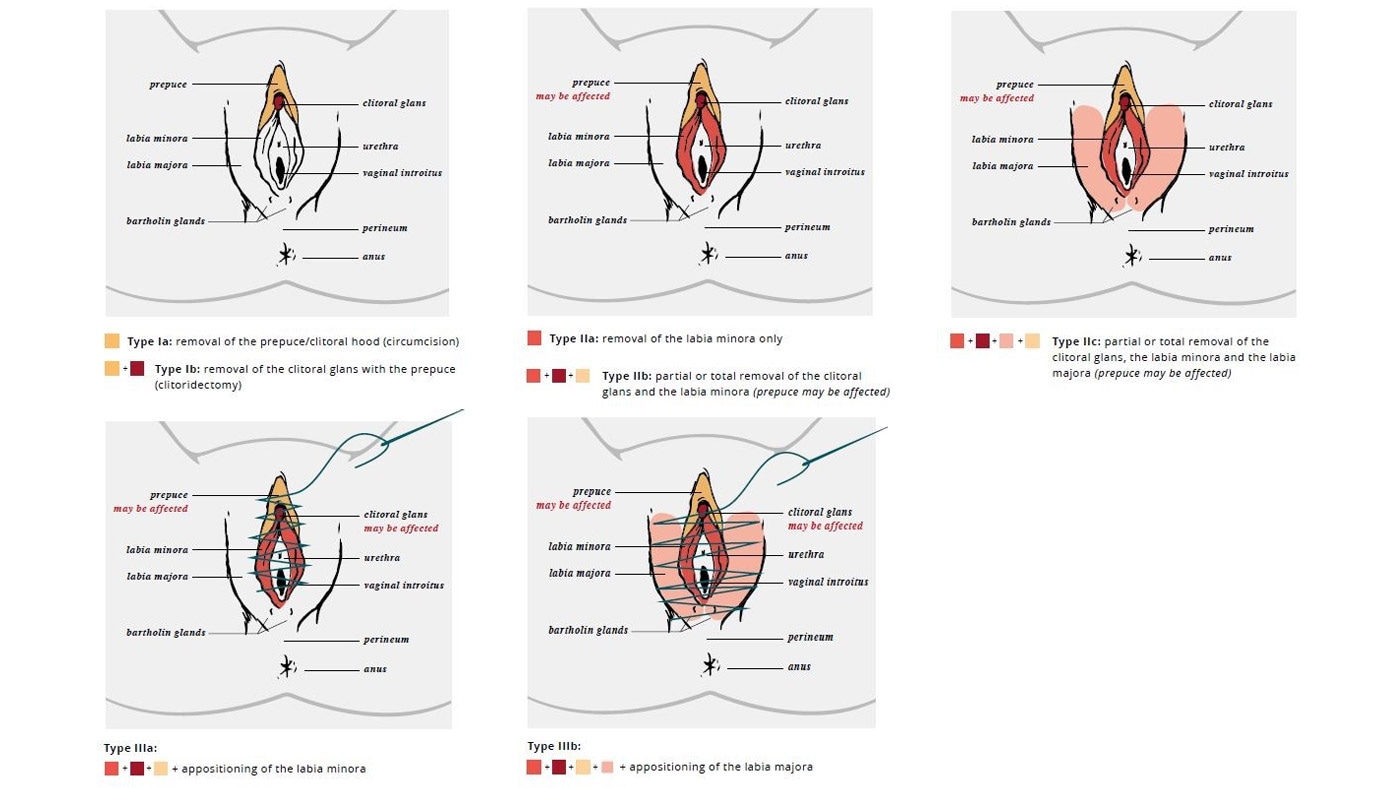 Figure 1. Clinical Drawings of FGM/C Types I, II, and III