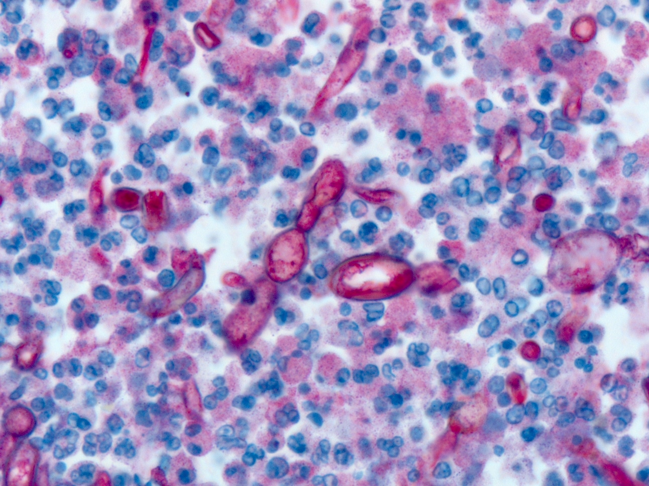 Immunohistochemistry (IHC) showing Exserohilum fungus in a case from the 2012 fungal meningitis outbreak