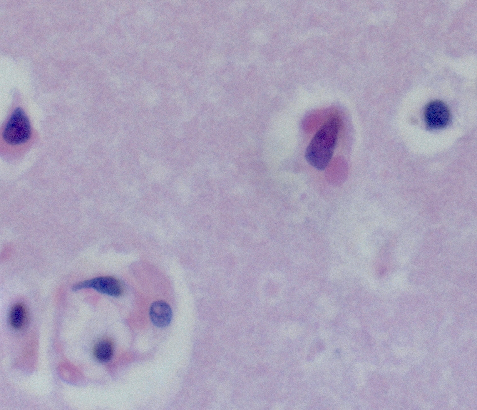 Neuron with Negri body inclusions of rabies virus in the brain of an organ donor