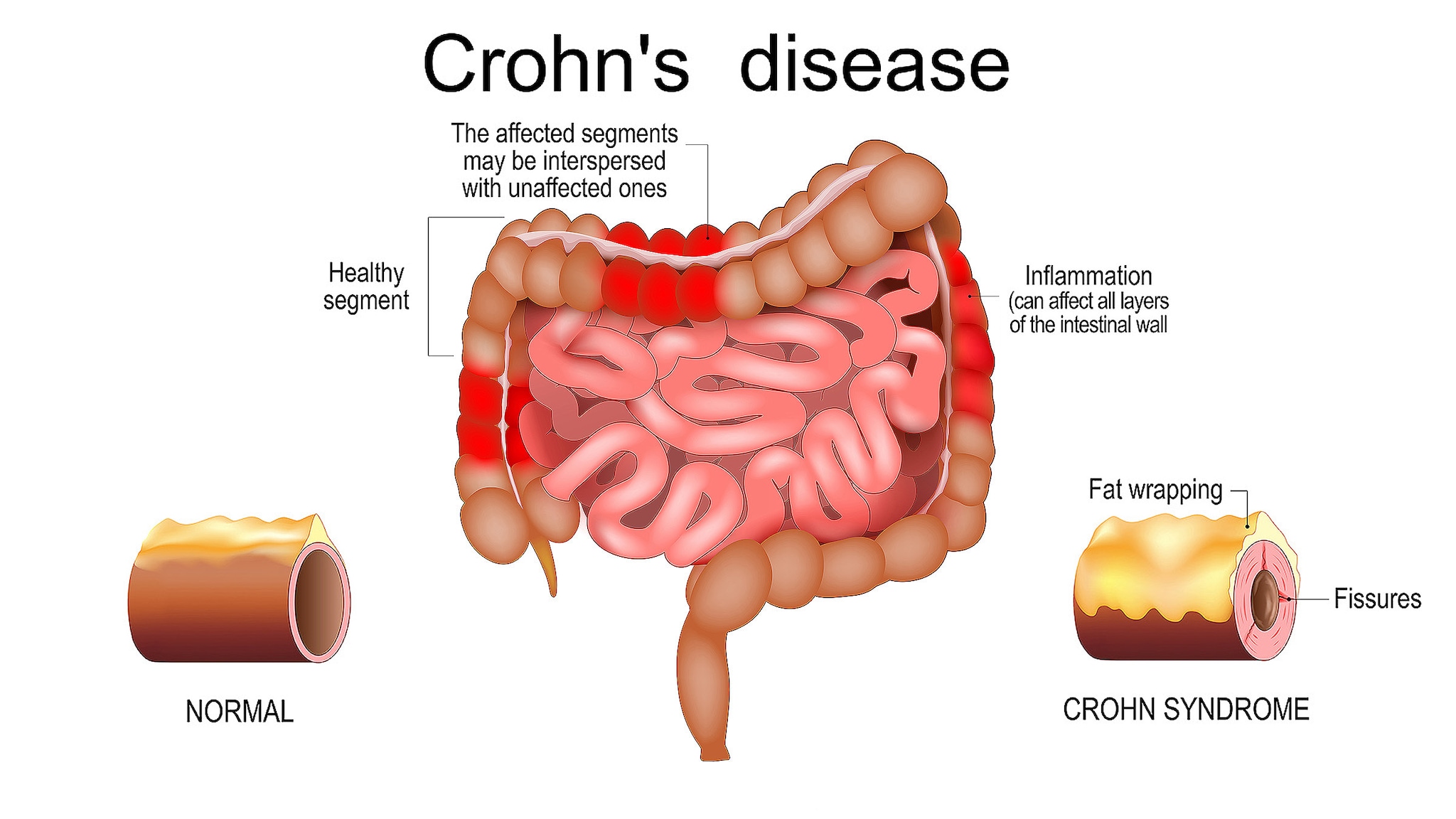 Illustrated diagram showing inflammation from Crohn's disease.