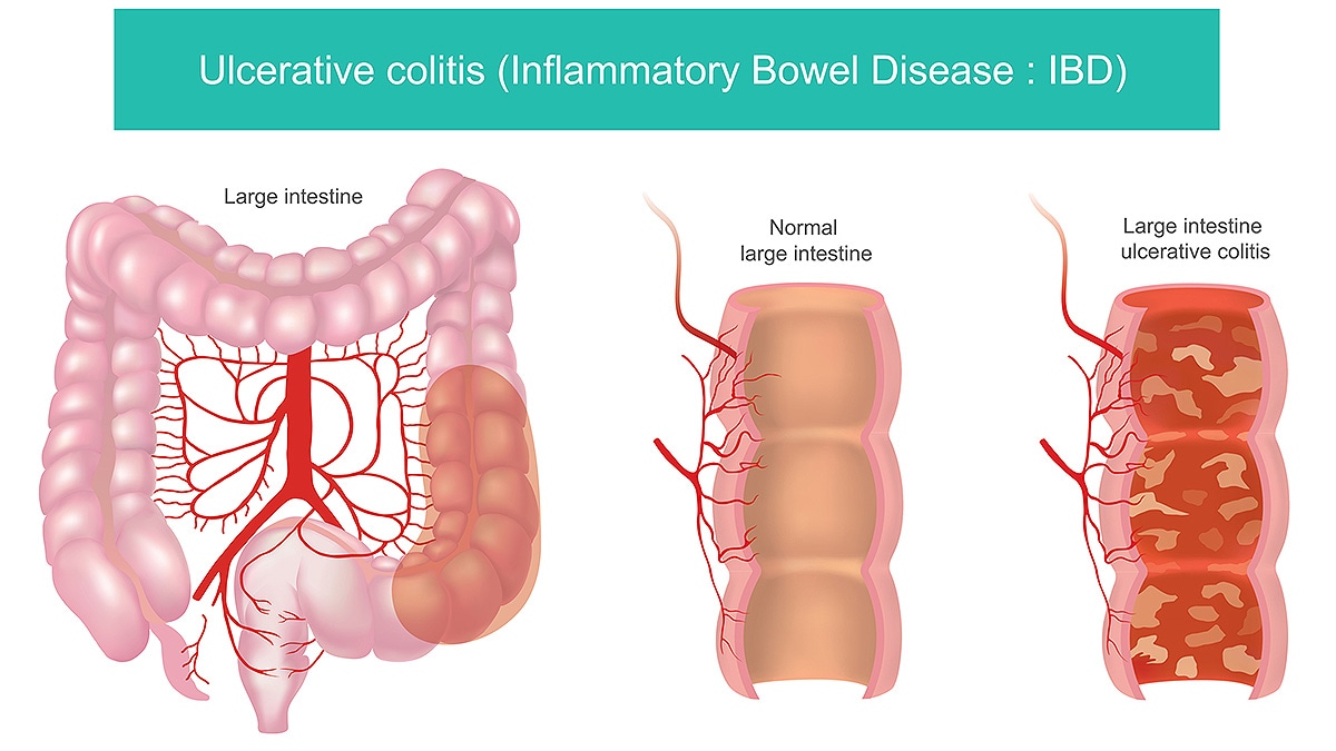 Illustrated diagram of a colon showing inflammation on the lining of the intestines.