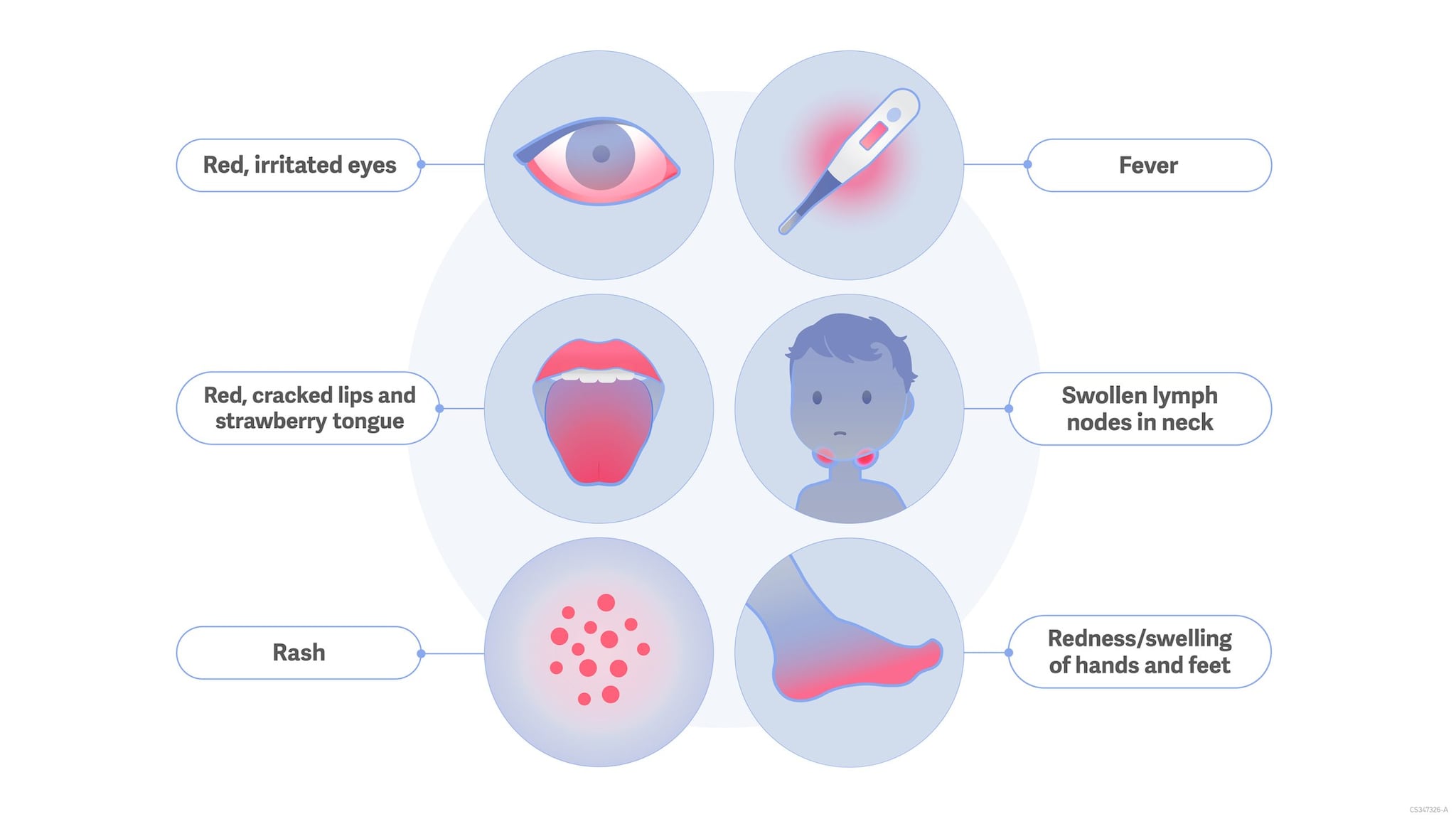 Illustration of Kawasaki Disease signs and symptoms, including red eyes, strawberry tongue, rash, fever, swollen lymph nodes, and red and swollen hands and feet