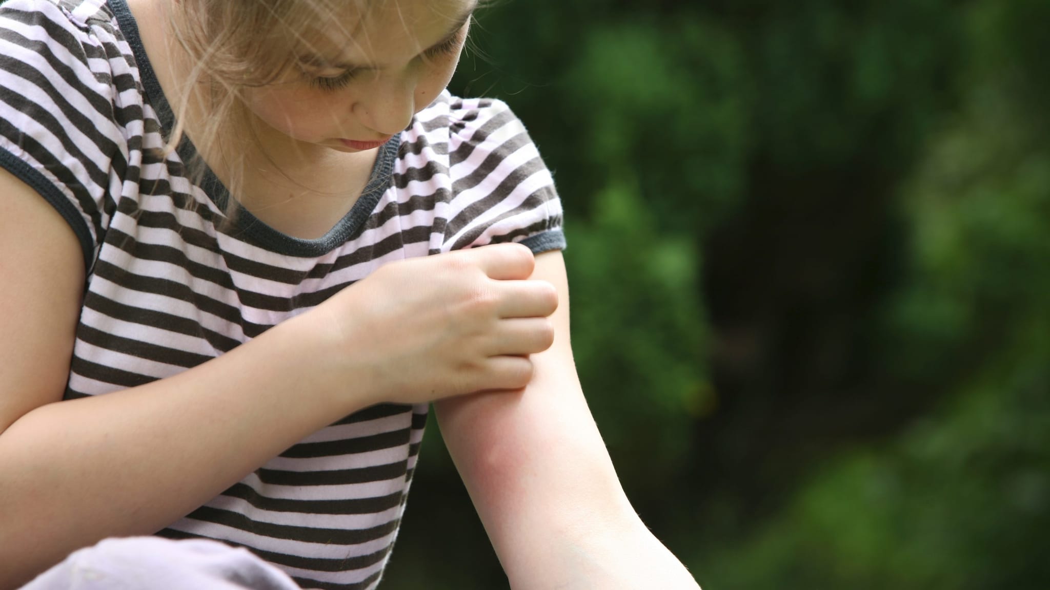 Child scratching a mosquito bite