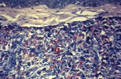 This acid-fast-stained photomicrograph of a tissue sample extracted from a patient with leprosy shows a chronic inflammatory lesion known as a granuloma, within which numerous red-colored M. leprae bacteria are visible.