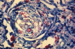 This photomicrograph of a skin tissue sample from a patient with Hansen's disease shows a cutaneous nerve, which had been invaded by numerous M. leprae bacteria (shown in red).