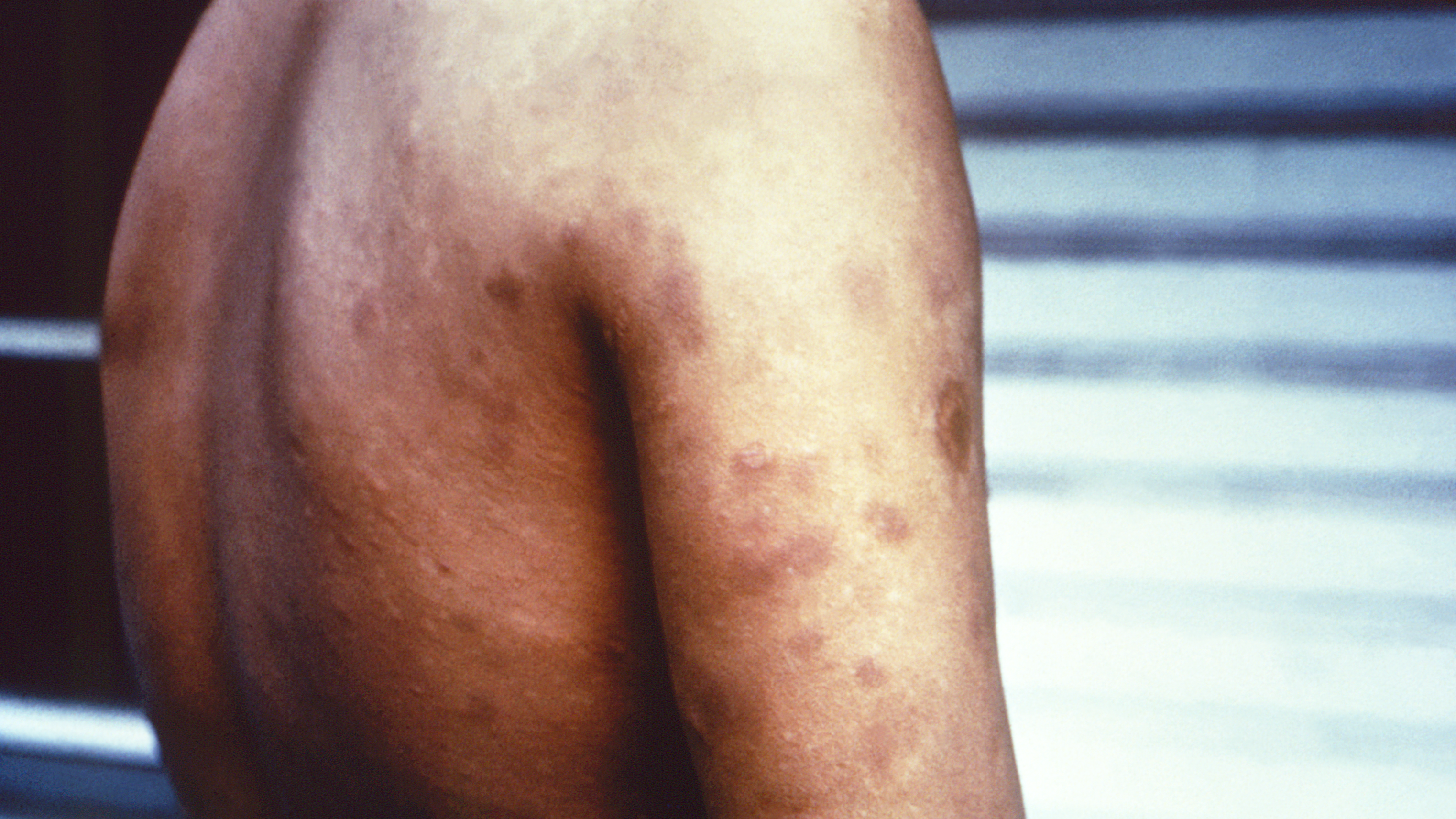 Leprosy lesions on a person's back and arms