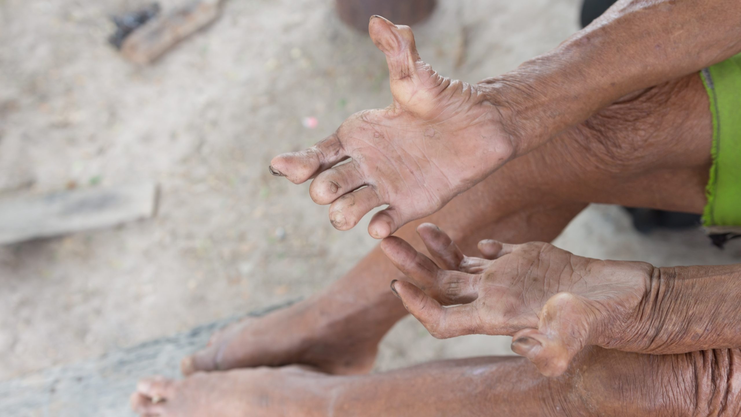 A person with untreated leprosy shows their hands and feet.