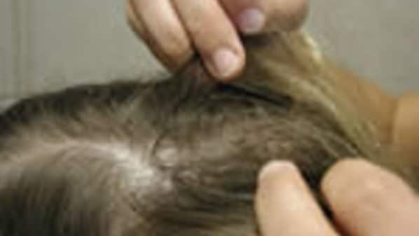 Head Lice Examination