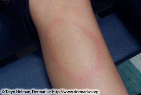 circular skin rashes that itch
