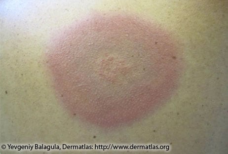 Circular rash: Causes and diagnosis