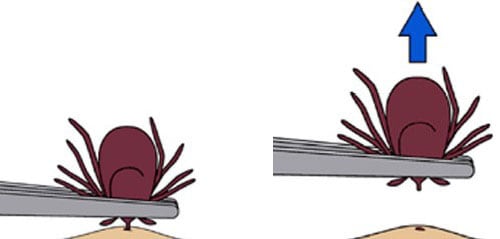 clipart style image illustrating the correct removal of a tick with the help of a tweezers
