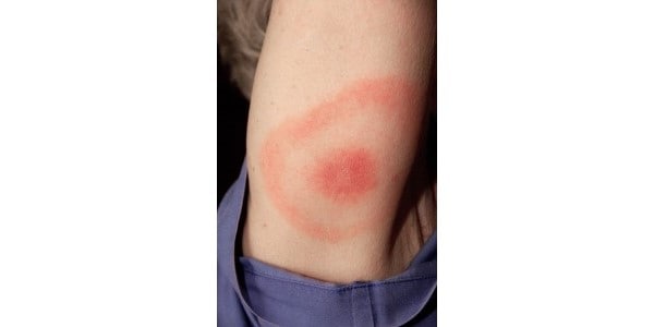Strong allergic reaction from sandfly bite (UPDATE: Borrelia