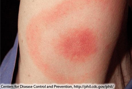 Close-up image of a circular, reddish, skin rash.
