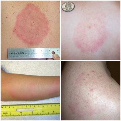Photo of different types of rashes caused by STARI