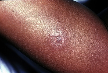 Close up image of a small, light, circular rash on dark skin.