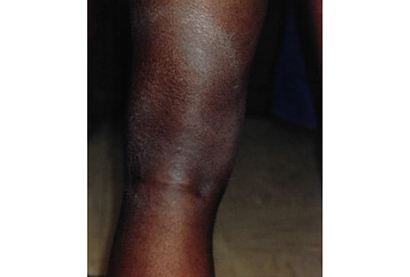 Image of a black person's back of knee showing a light colored circular rash taking up the majority of the back of the calf.