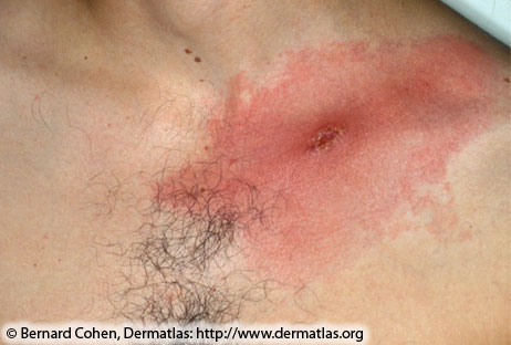 Close up image of a red rash on the skin with hair next to it.