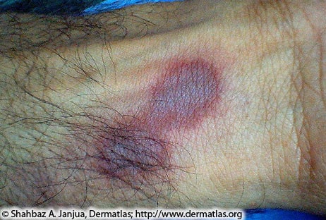 Close up image of a person's limb with a dark hyperpigmented circular shape appearing right next to a growth of hair.