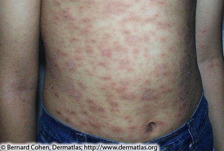 Image of a person's torso with small, raised, reddish-brownish rashes spotted throughout their entire stomach surface.