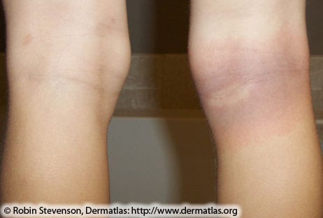 Close up image of a person's back of knees, with a purple hued rash developing on the back of the right knee.