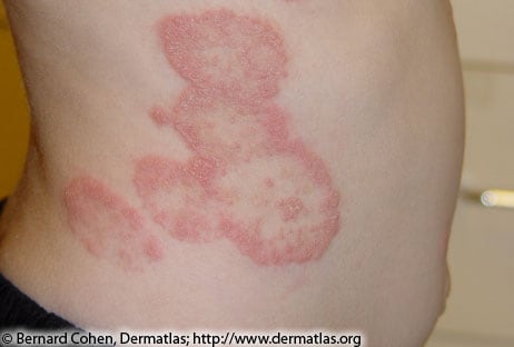 Close up image of a person's torso from the side, with multiple raised, redish skin lesions in circular shapes going down their side.