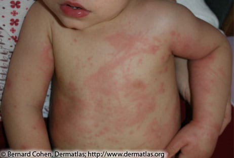 Close up image of a white infant's chest and arms. They have multiple defined spots of red color flushed in their skin.