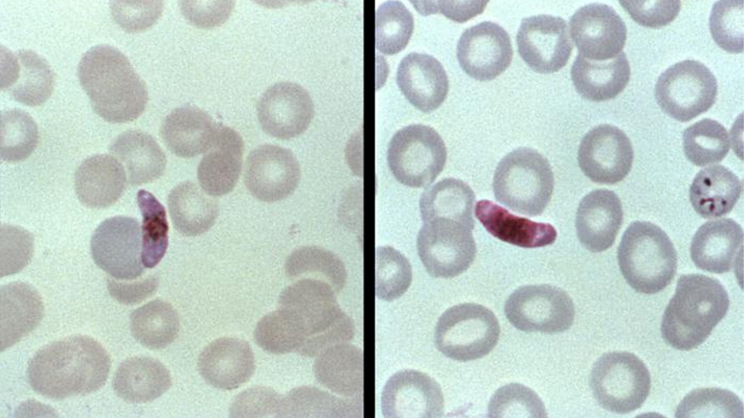 A side-by-side comparison of a Plasmodium falciparum macrogametocyte to a microgametocyte, as shown in a blood smear.