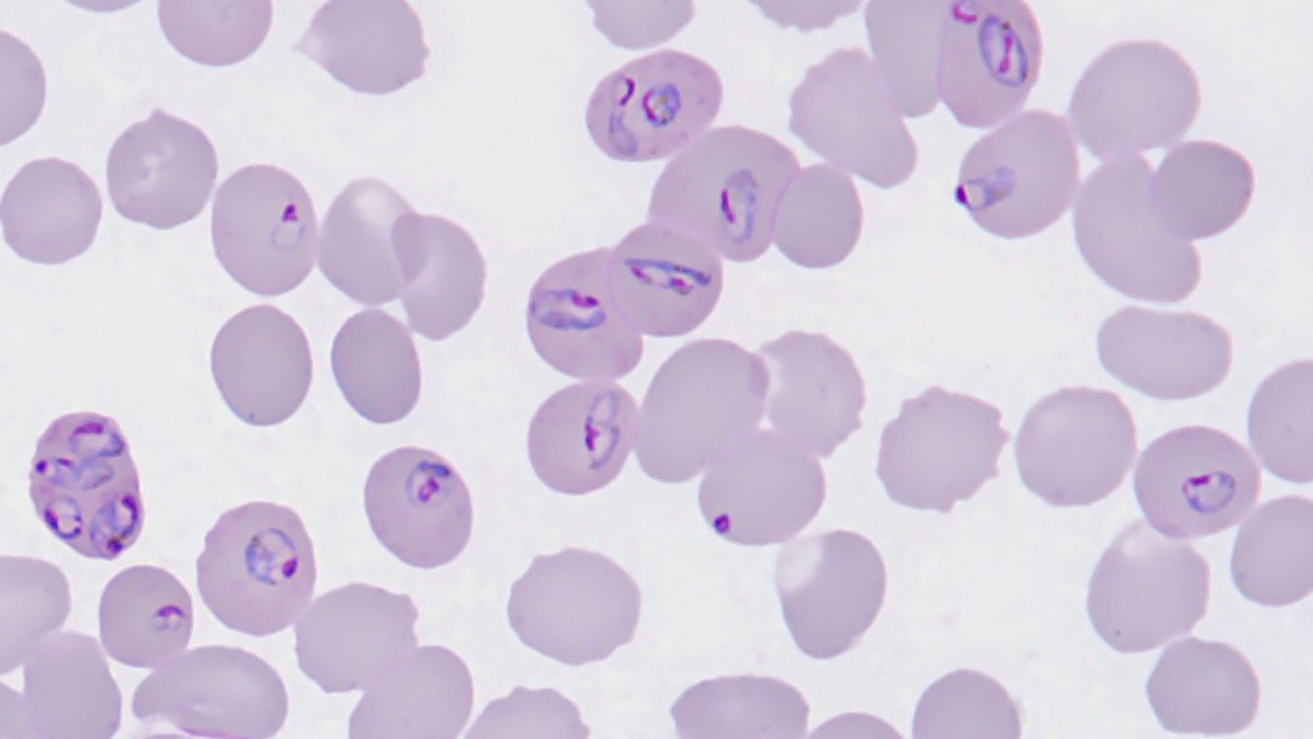 A magnified blood smear shows the single-celled protozoan P. falciparum parasite.