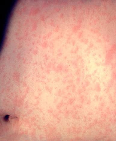 Measles skin rash on stomach.