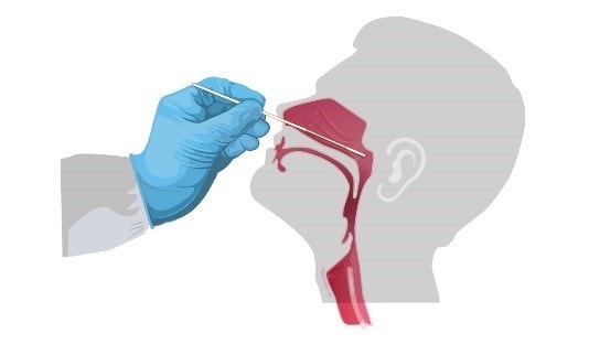 Image of a nasopharyngeal swab.