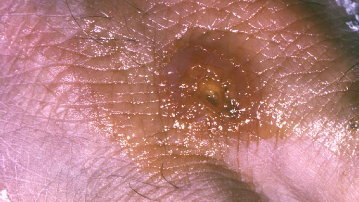Tularemia — United States, 2011–2022 The photo shows a tularemia lesion on the dorsal skin of the right hand, caused by the bacterium Francisella tularensis.