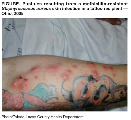 Infected tattoos linked to distilled water in ink