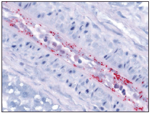 rr6502a1f20.gif This figure is a photograph showing an immunohistochemical stain demonstrating Rickettsia rickettsii (red) in infection of blood vessel endothelial cells.